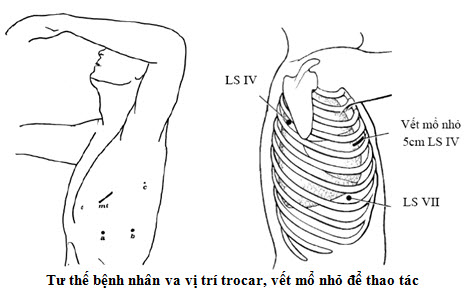 Cắt thùy phổi trong điều trị ung thư phổi bằng phẫu thuật nội soi lồng ngực