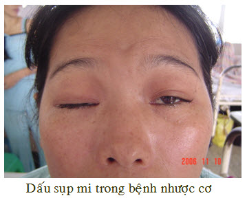 Phẫu thuật nội soi cắt tuyến hung trong điều trị bệnh nhược cơ