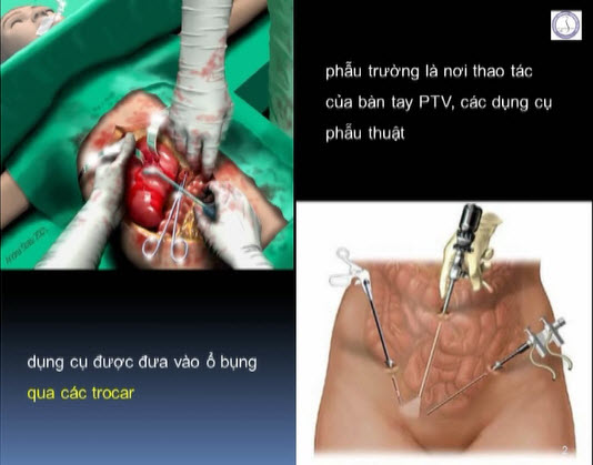 Các nguyên tắc chọn vị trí trocar trong PTNS