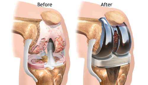 PHẪU THUẬT THAY KHỚP GỐI CĂN BẢN