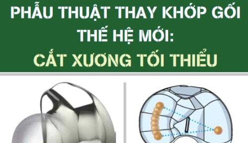 (05/07/2017) Hội thảo chuyên đề: Phẫu thuật thay khớp gối thế hệ mới: Cắt xương tối thiểu