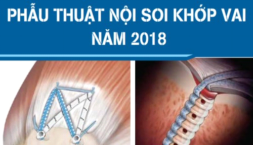 (05/10/2018) Phẫu thuật nội soi khớp vai năm 2018